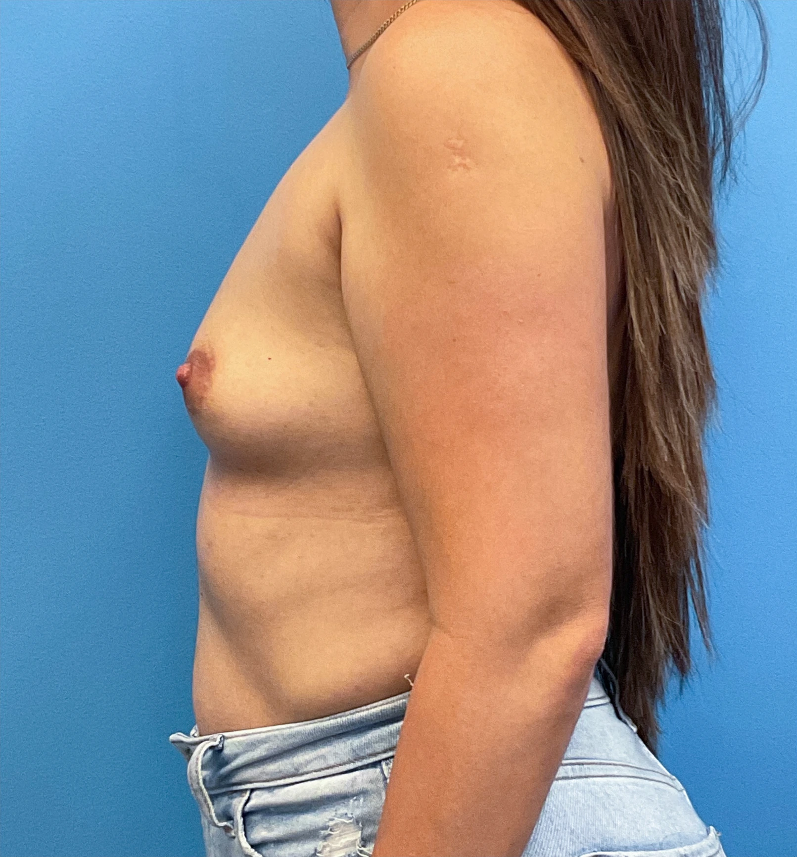 Breast-Augmentation-Case--25743 | Before Breast Augmentation 3