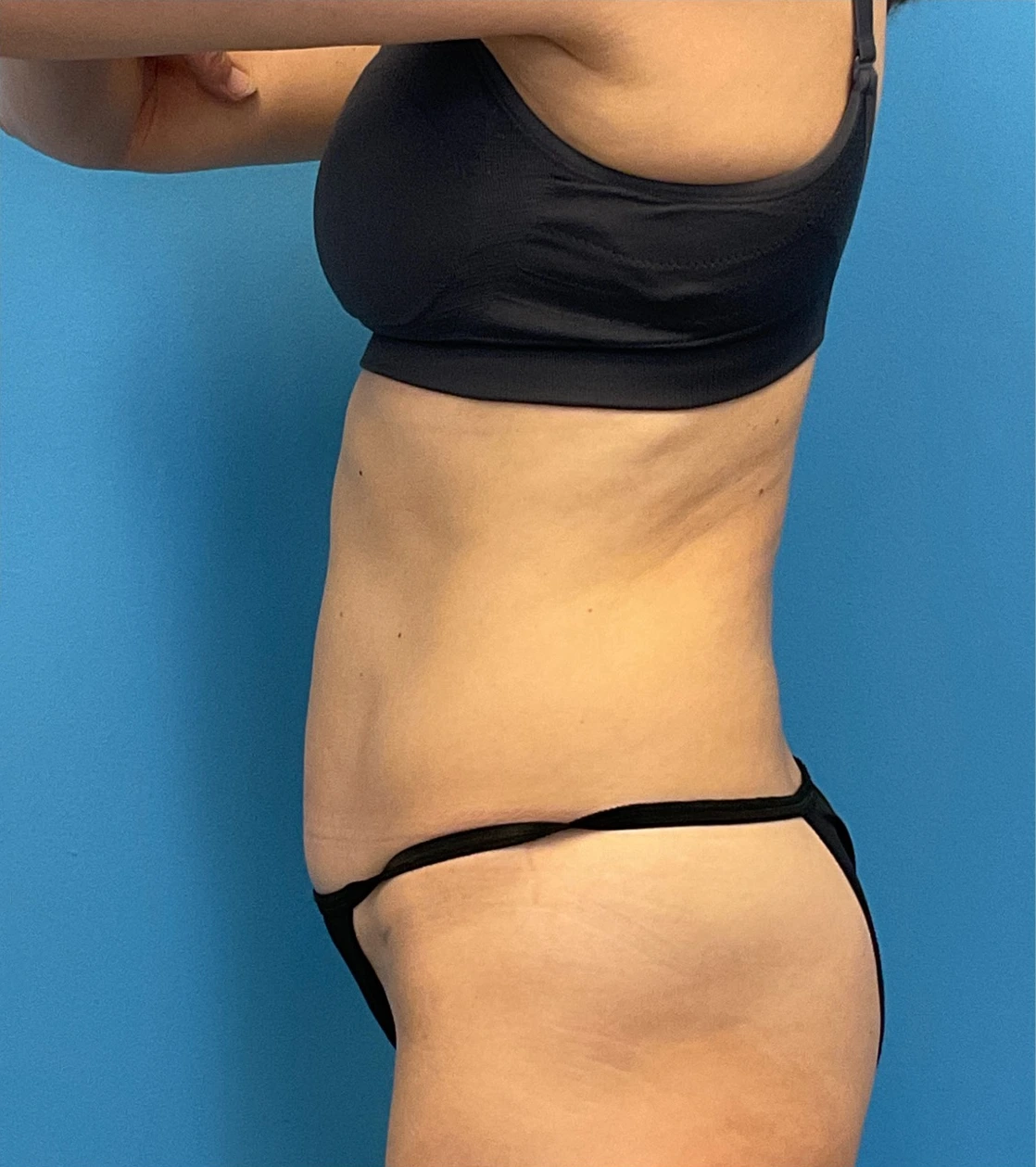 Revision-Tummy-Tuck-Case--23643 | Before Tummy Tuck 3