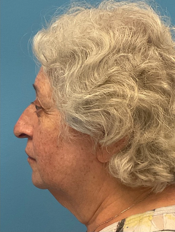 Rhinoplasty-Case--25467 | Before Rhinoplasty 4