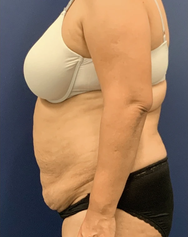 Liposuction-Abdominoplasty-Case--25576 | Before Liposuction 5