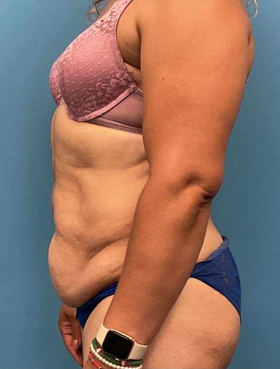 Tummy-Tuck-Case--25988 | Before Tummy Tuck 3