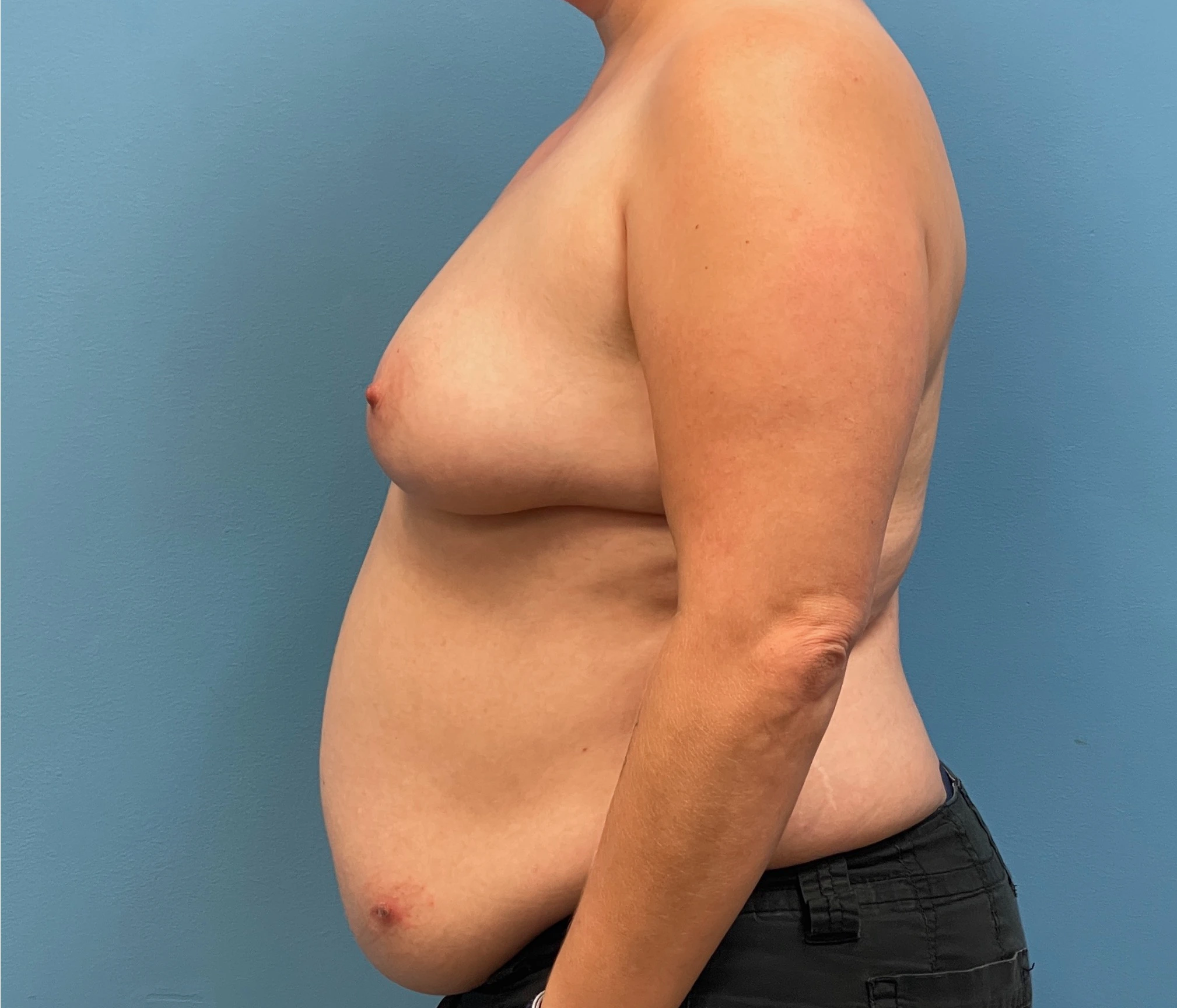 DIEP-Flap-Case--28021 | Before DIEP Flap 2