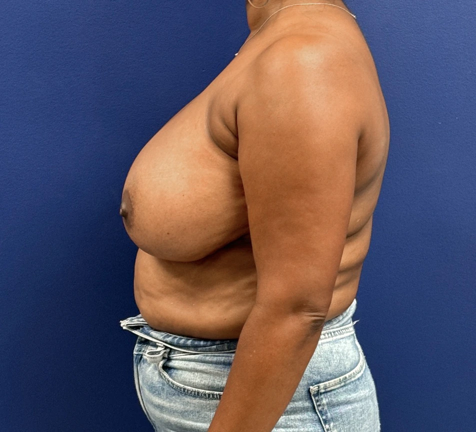 Breast-Reduction-Case--28242 | Before Breast Reduction 2