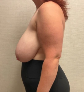 Breast-Reduction-Case--28338 | Before Dr. Samir Rao 2