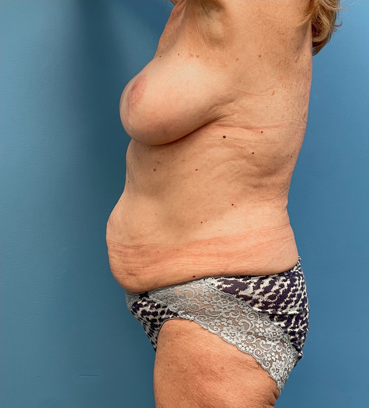 Lipoabdominoplasty-Case--27935 | Before Liposuction 3