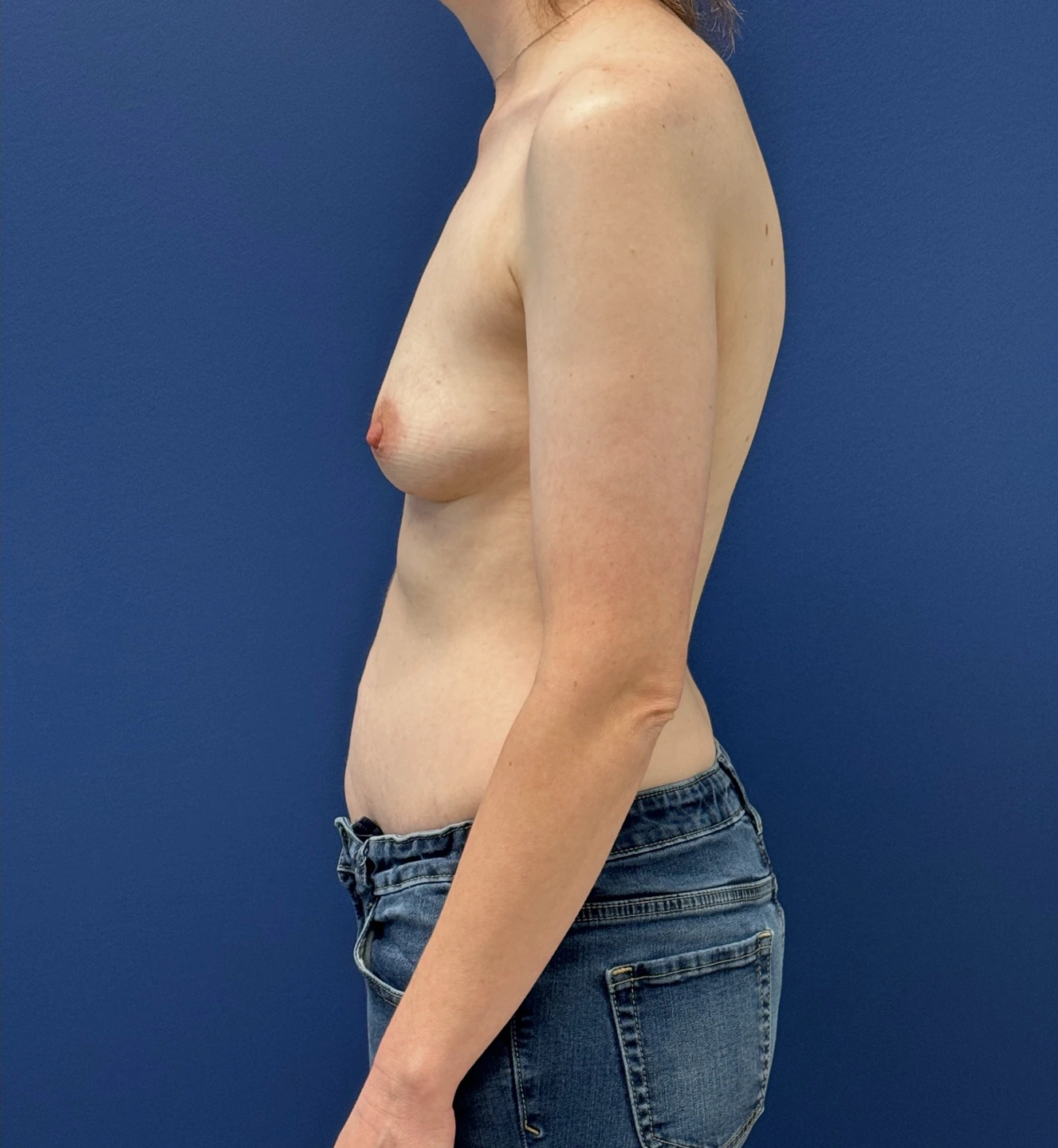 Breast-Augmentation-Case--28670 | Before Breast Augmentation 3
