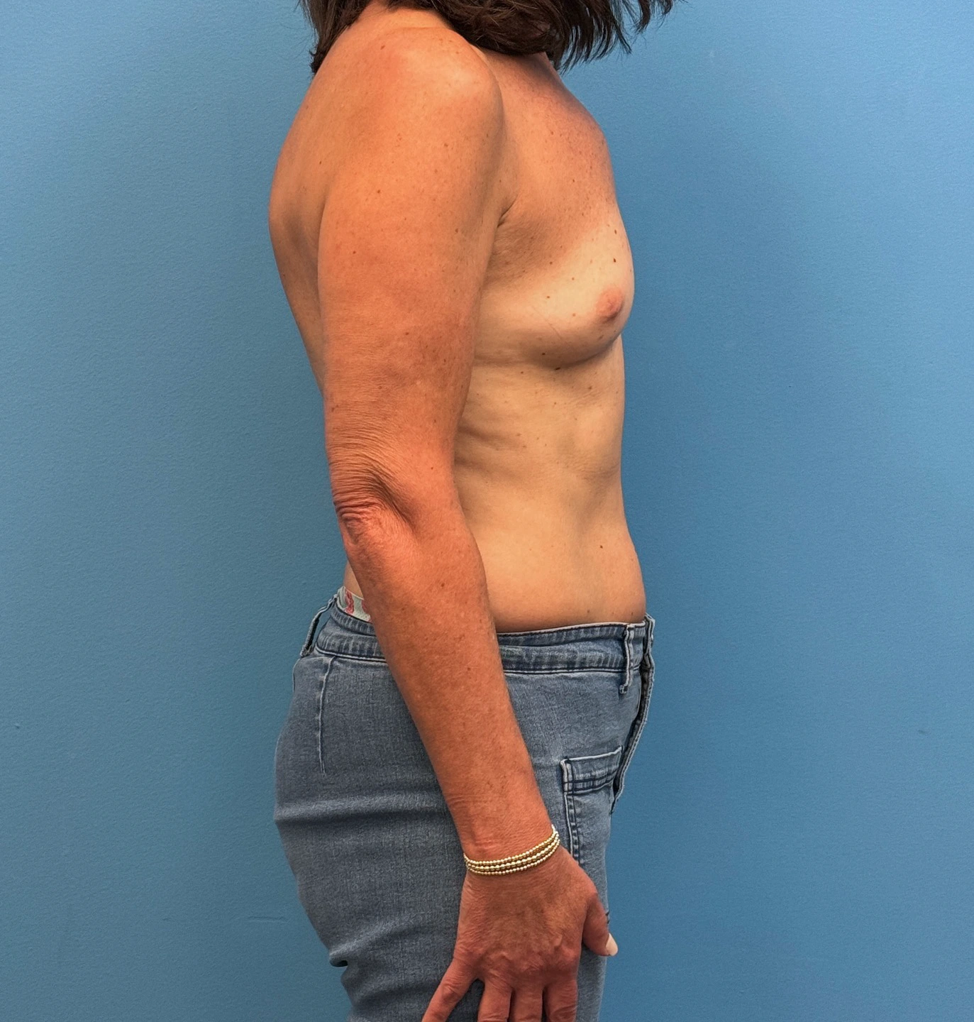 Breast-Reconstruction-Case--28688 | Before Breast Reconstruction 2