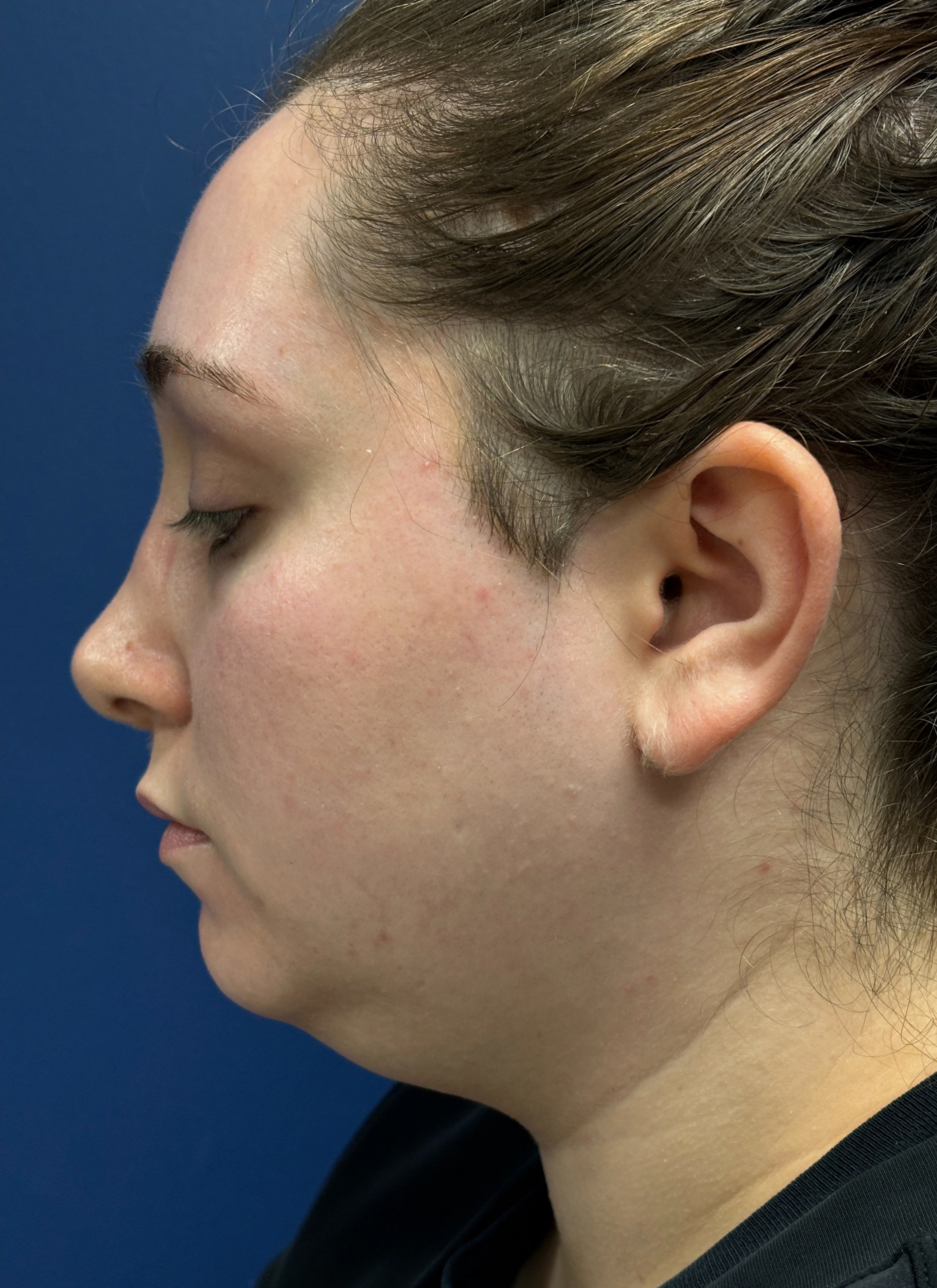 Submental-Liposuction-Case--29107 | Before Submental Liposuction 3