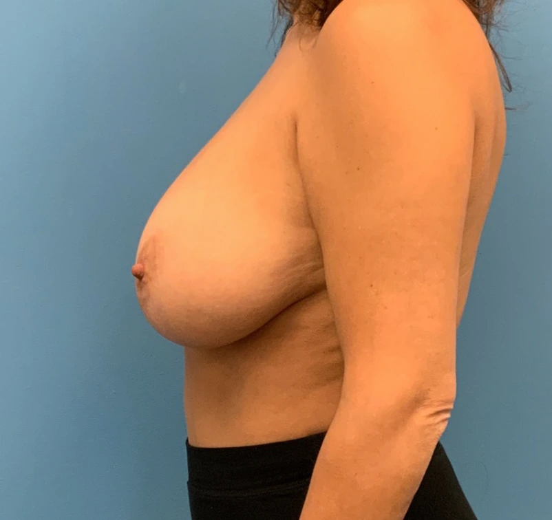 Breast-Reduction-Case--10070 | Before Breast Reduction 5