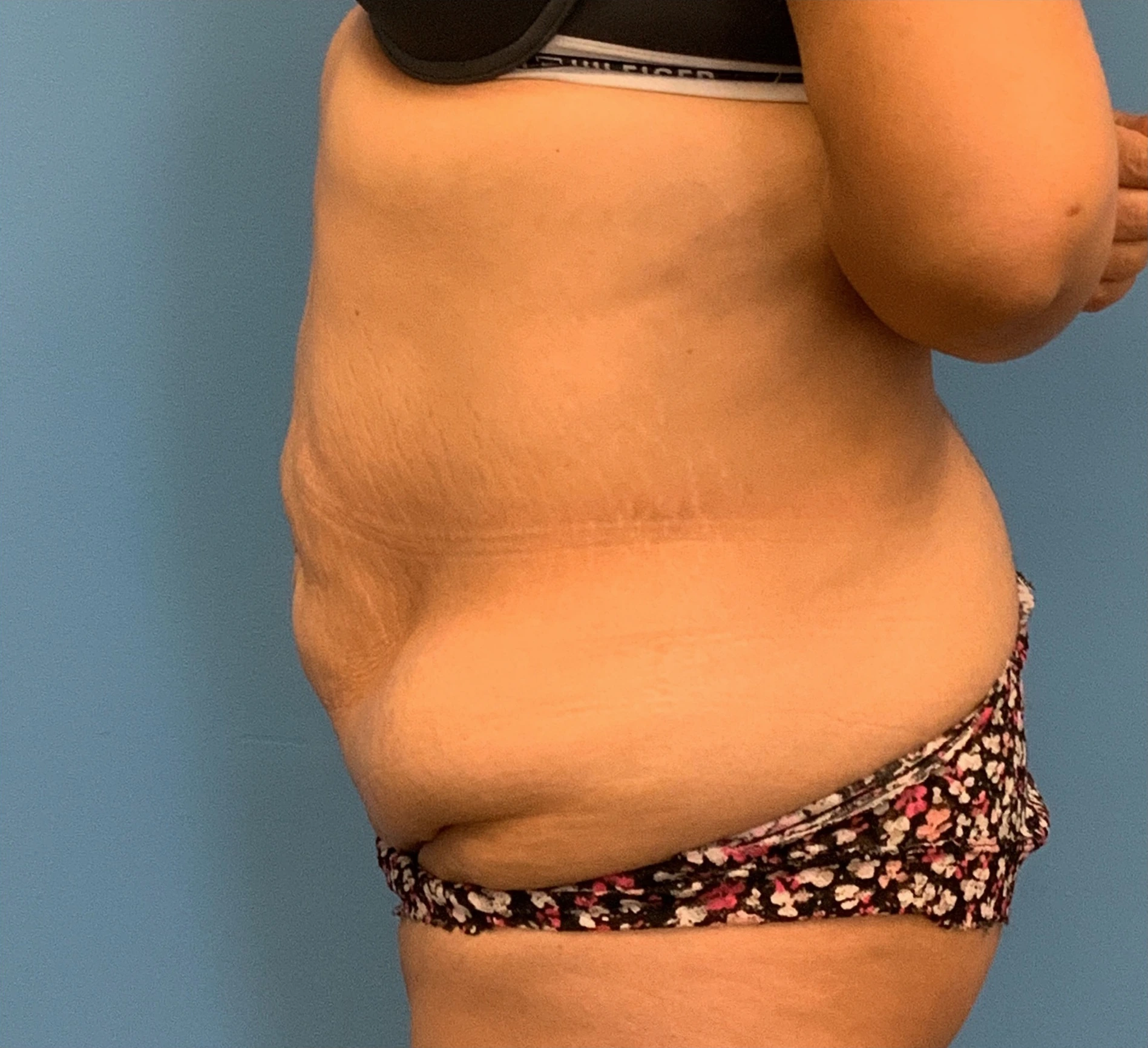 Abdominoplasty-Case--23747 | Before Tummy Tuck 3
