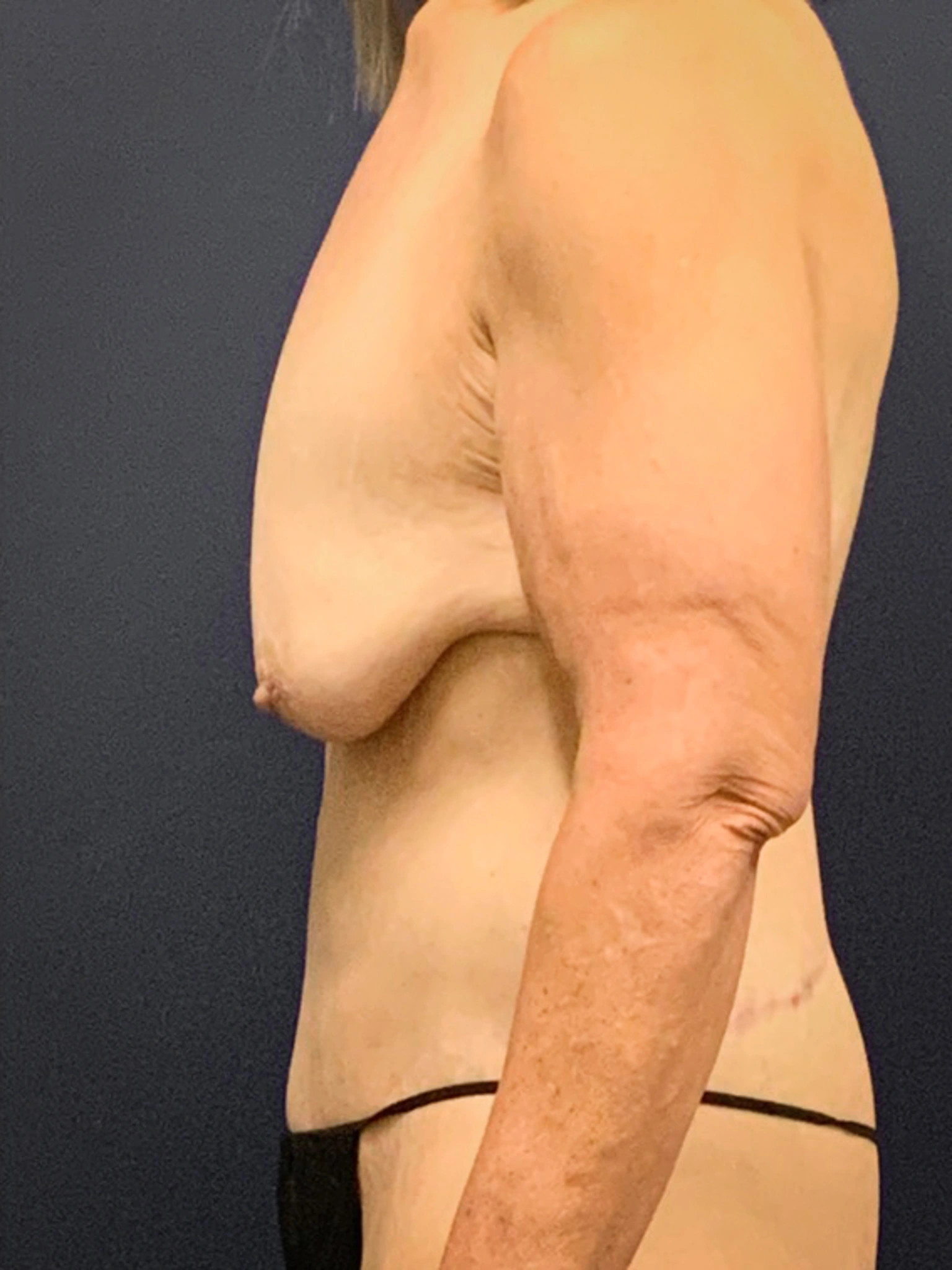 Augmentation-Mastopexy-Case--3055 | Before Breast Augmentation With Lift 2