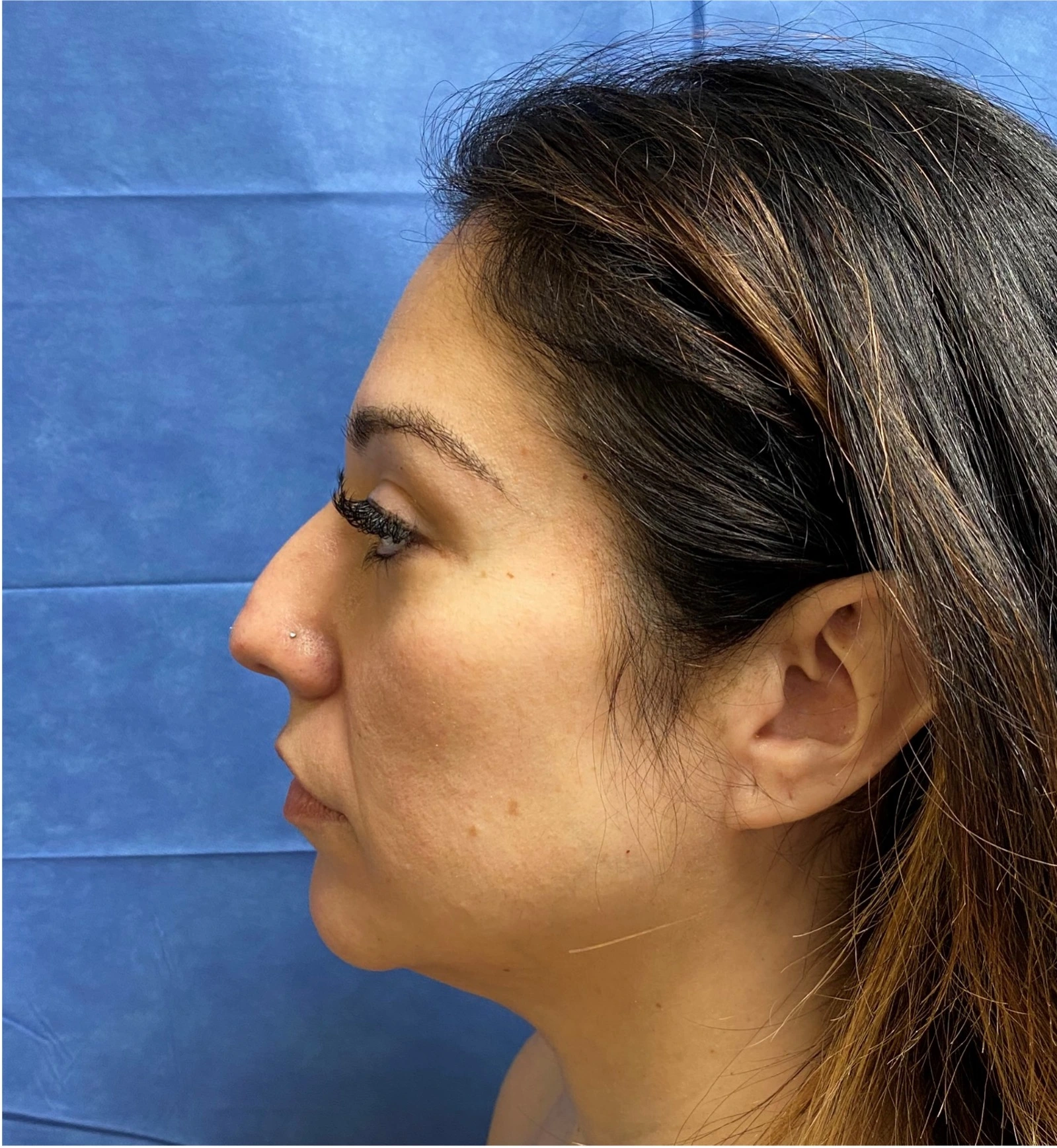 Rhinoplasty-Case--377 | Before Rhinoplasty 2
