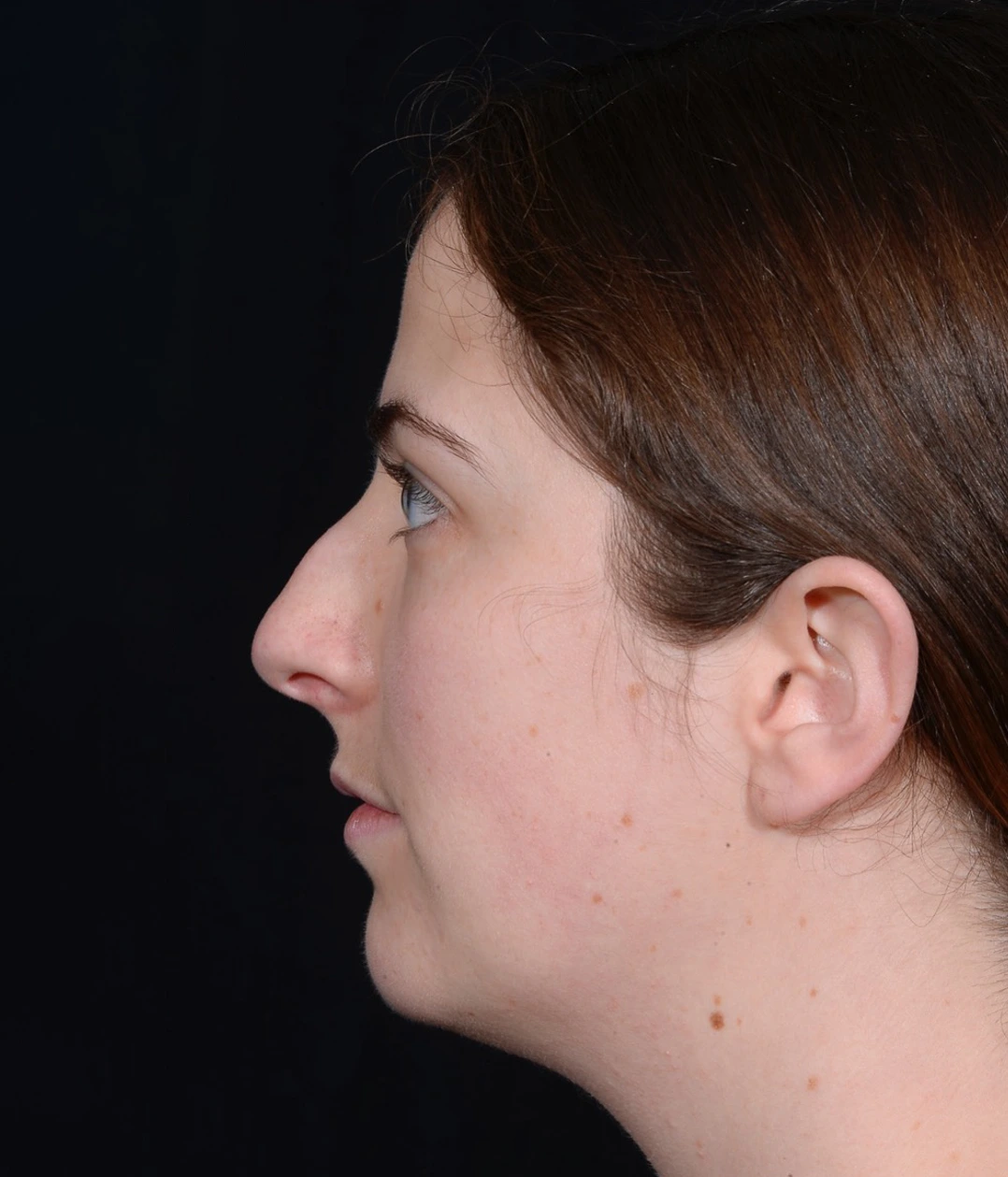 Rhinoplasty-and-Chin-Implant-Case--381 | Before Rhinoplasty 3