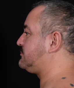 Liposuction-Case--368 | Before Submental Liposuction 2