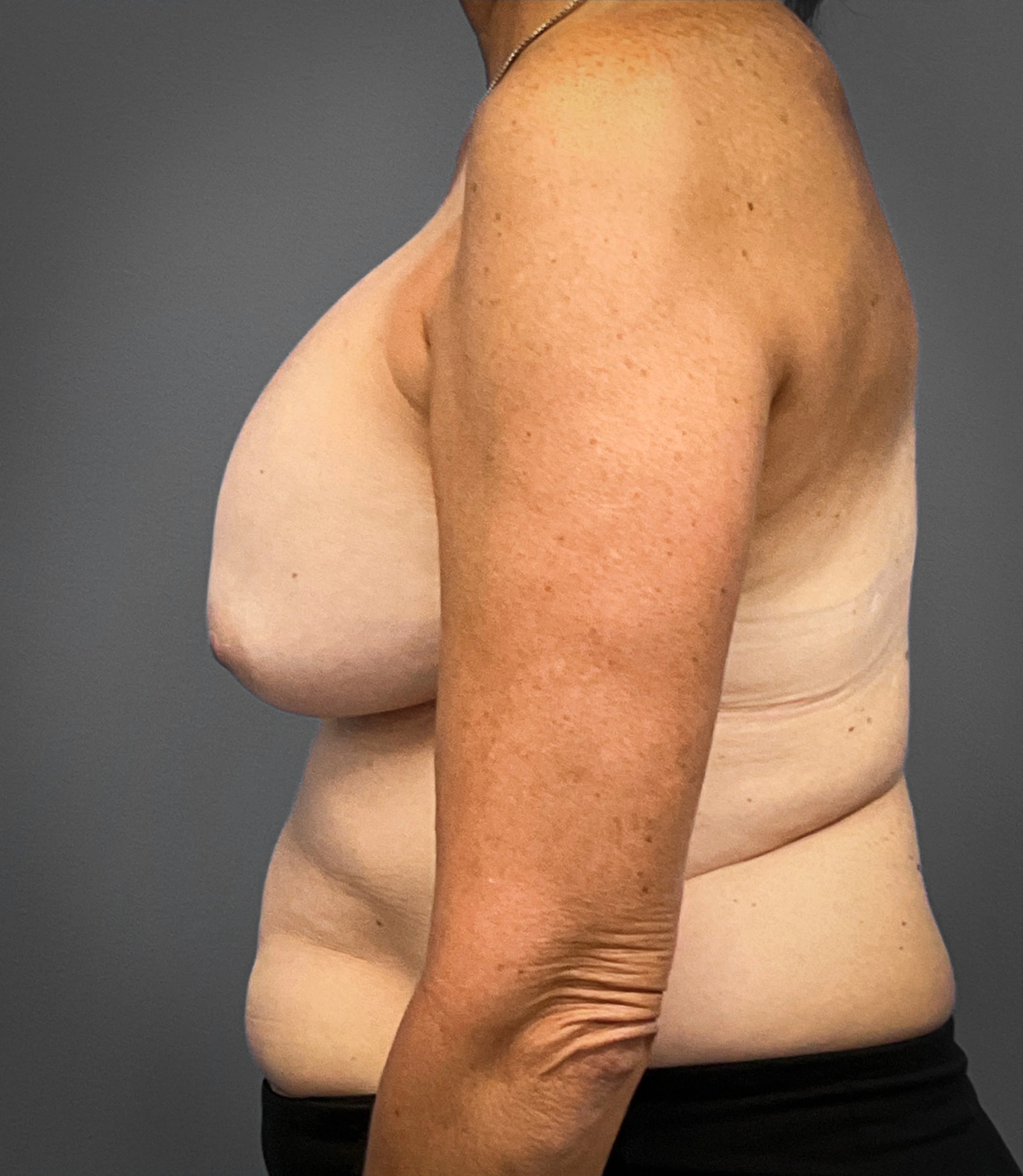 Augmentation-Mastopexy-Case--1213 | Before Breast Augmentation With Lift 4