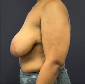 Breast-Reduction-Case--5320 | Before Dr. Arjun Kanuri 2