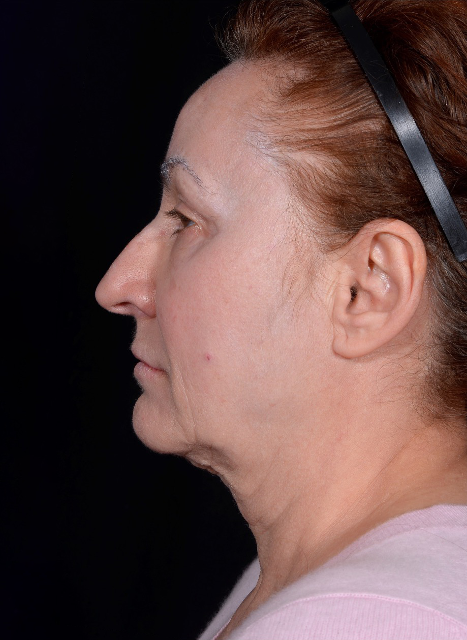 Facelift-Case--363 | Before Facelift 2