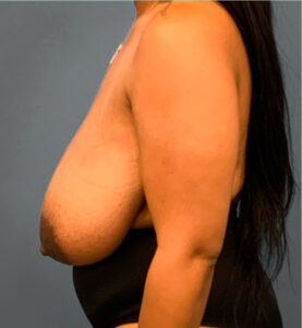 Breast-Reduction-Case--2564 | Before Dr. Arjun Kanuri 2