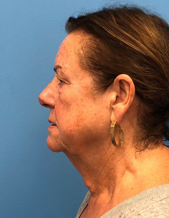 Facelift-Case--14406 | Before Eyelid Surgery 3