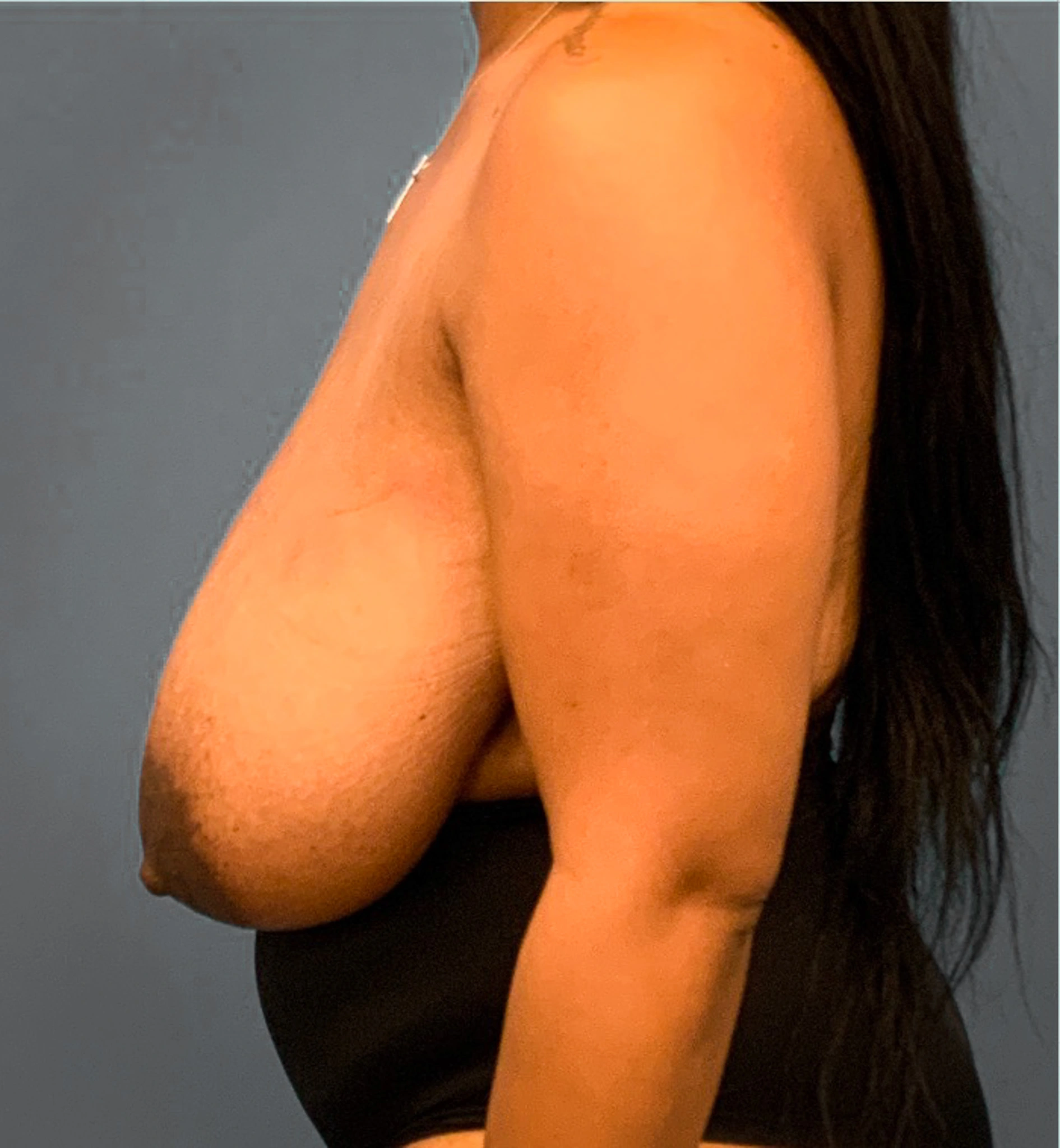 Breast-Reduction-Case--2564 | Before Breast Reduction 2