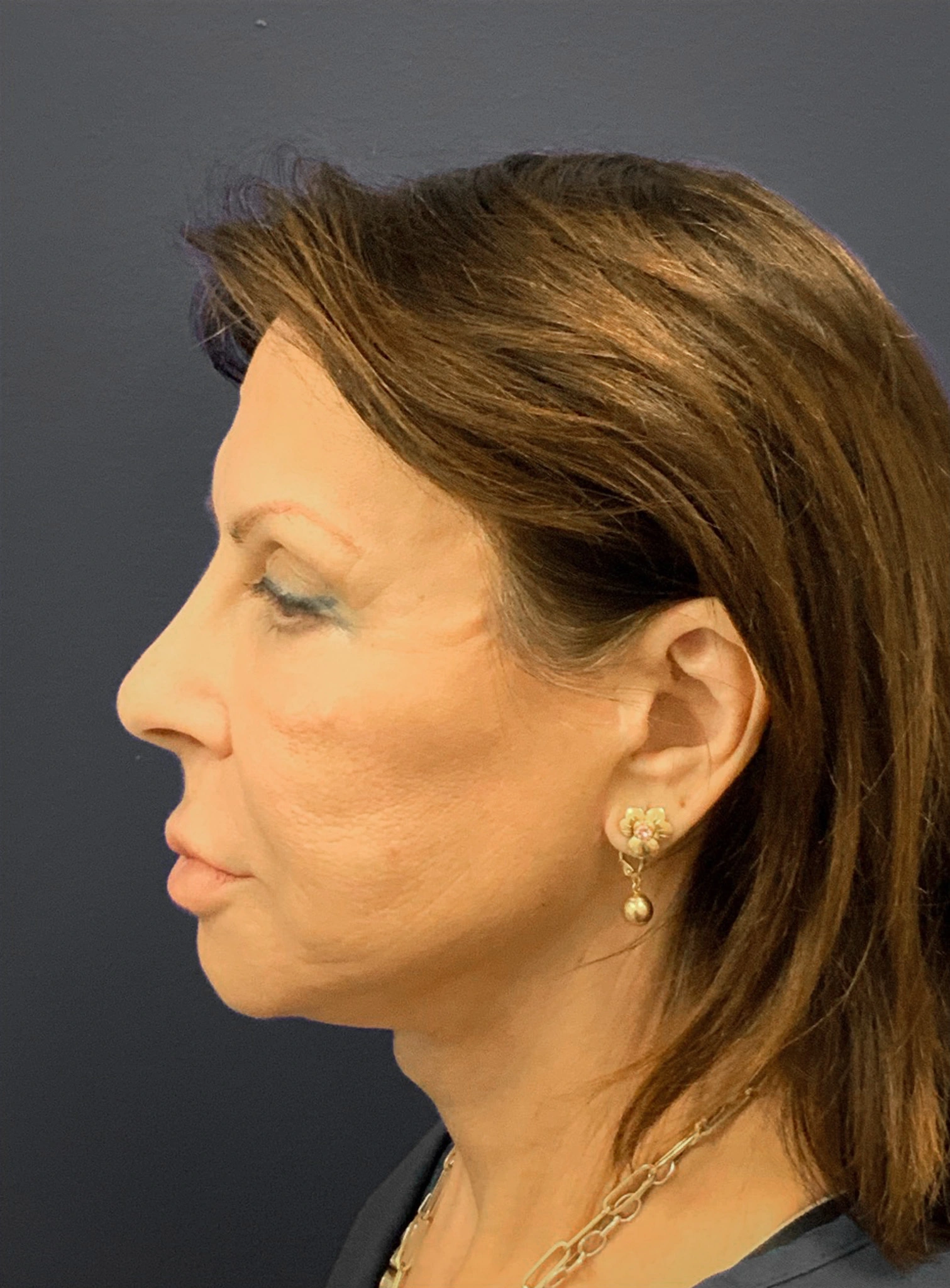 Blepharoplasty-Case--6272 | Before Eyelid Surgery 6