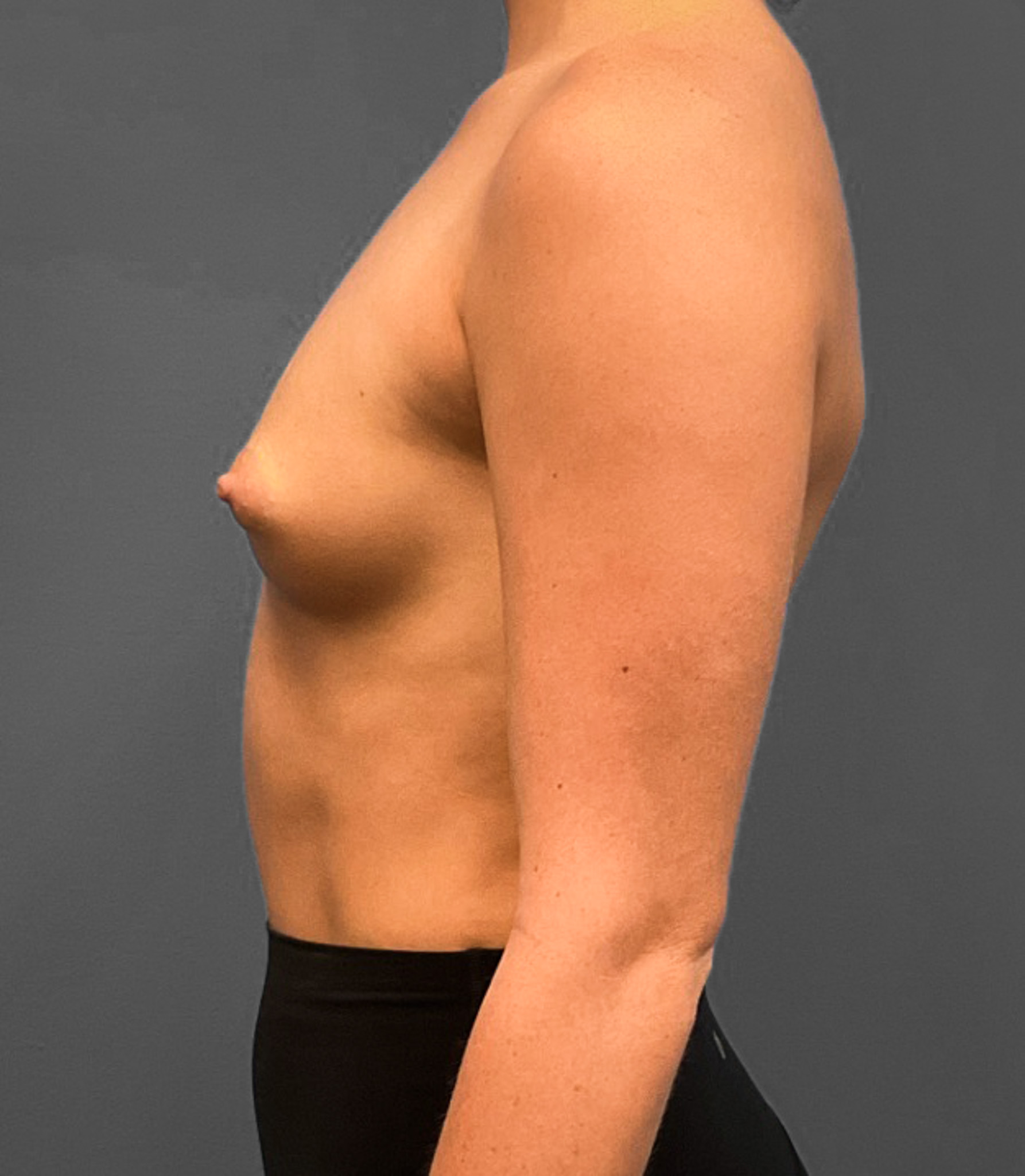 Breast-Augmentation-Case--2384 | Before Breast Augmentation 2