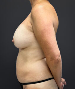 Mastopexy-Case--1663 | Before Dr. Frank Albino 2