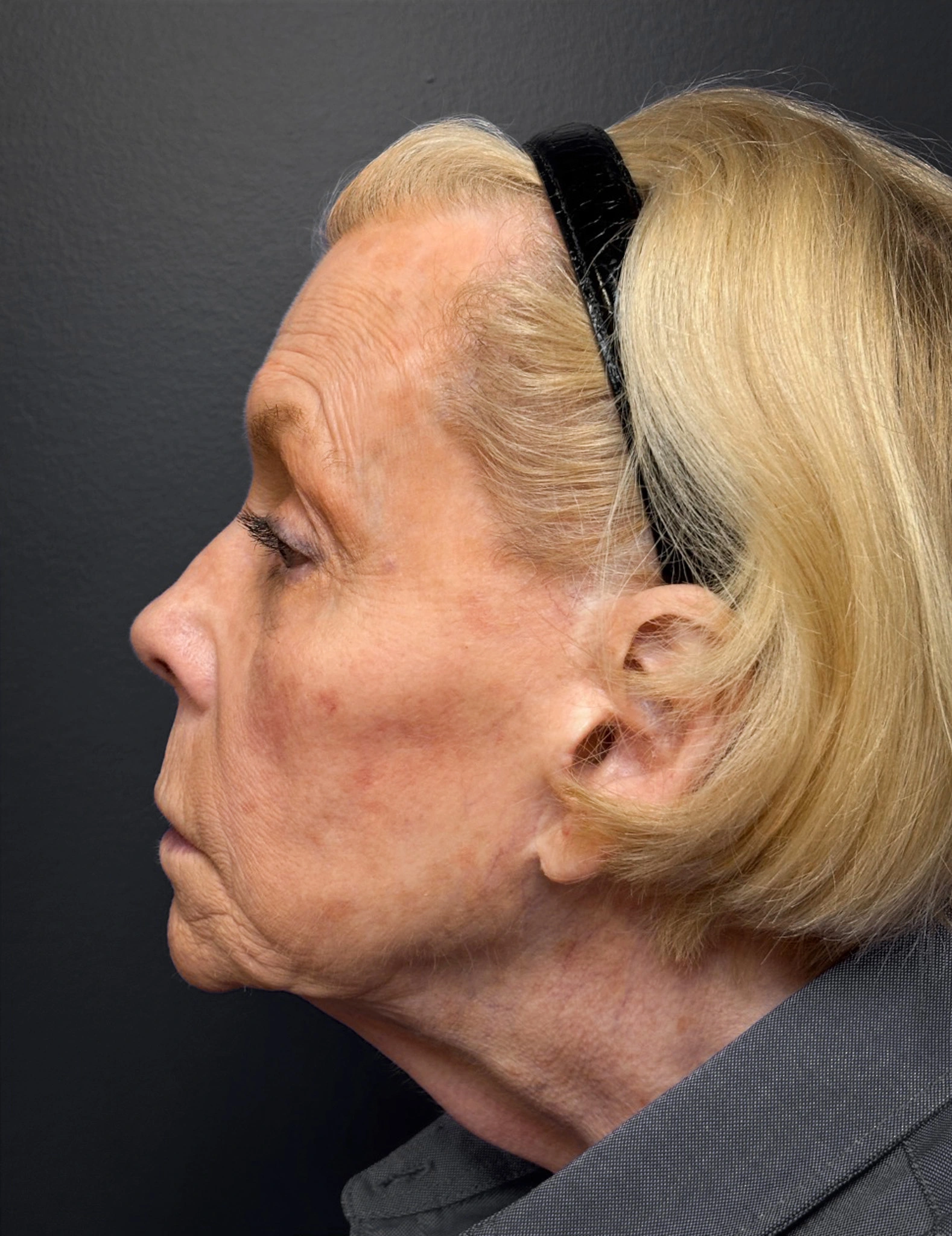 Facelift-Case--7247 | Before Facelift 3