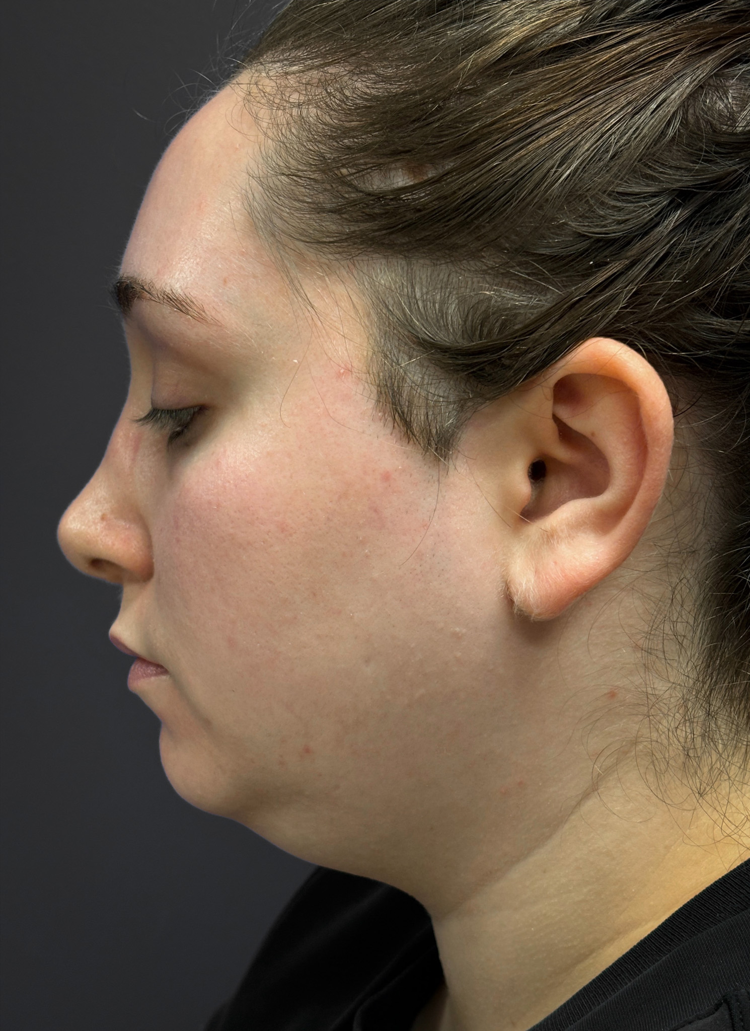 Submental-Liposuction-Case--3439 | Before Submental Liposuction 3