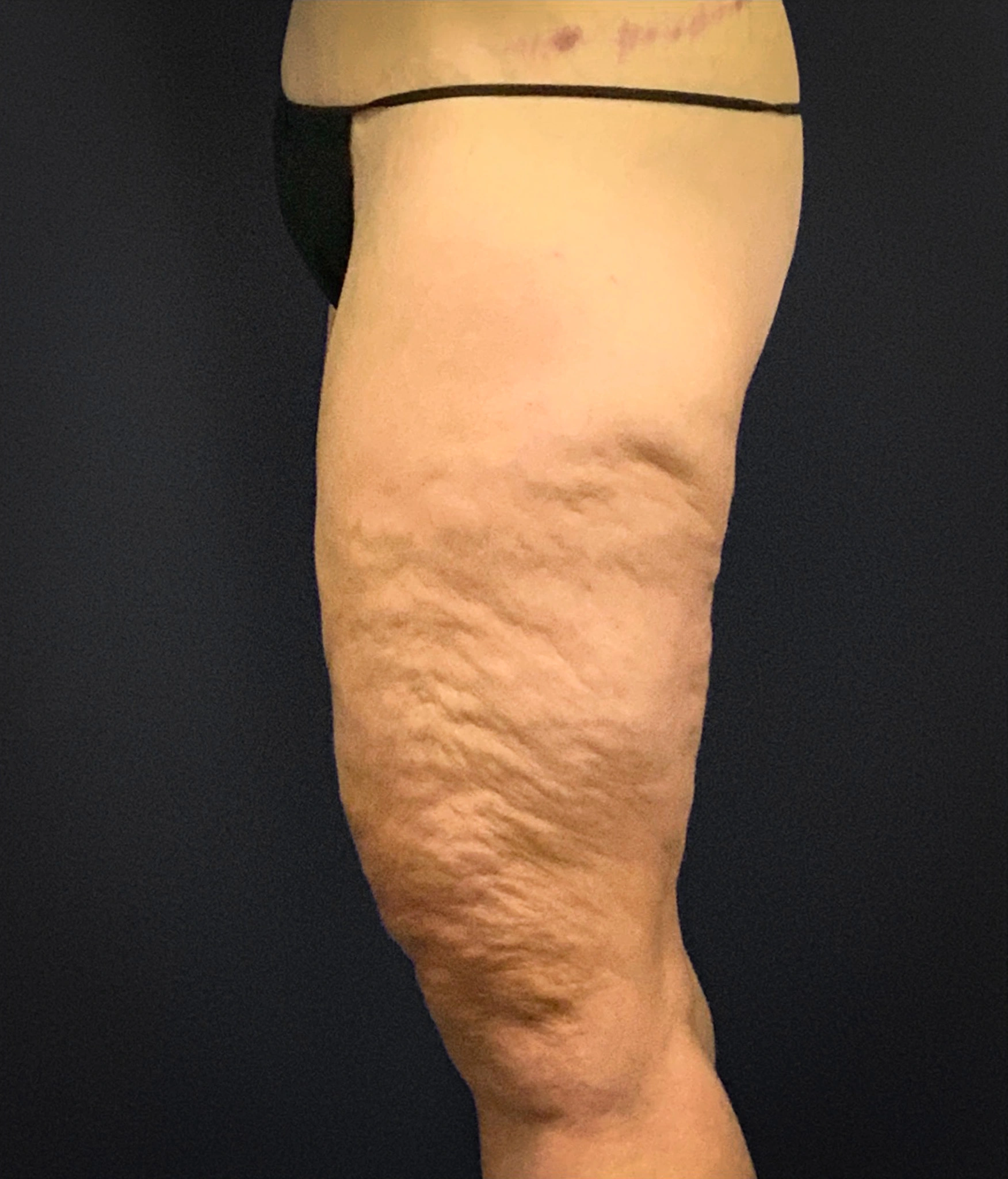 Thighplasty-Case--2024 | Before Thigh Lift 3