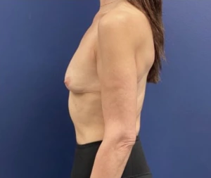 Subfascial-Breast-Augmentation-Case--26649 | Before Breast Augmentation 2