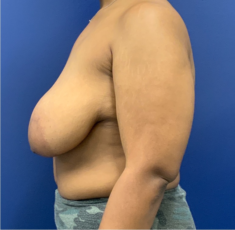 Breast-Reduction-Case--27281 | Before Breast Reduction 3