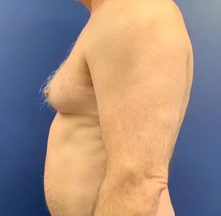 Gynecomastia-Case--20376 | Before Gynecomastia / Male Breast Reduction 3
