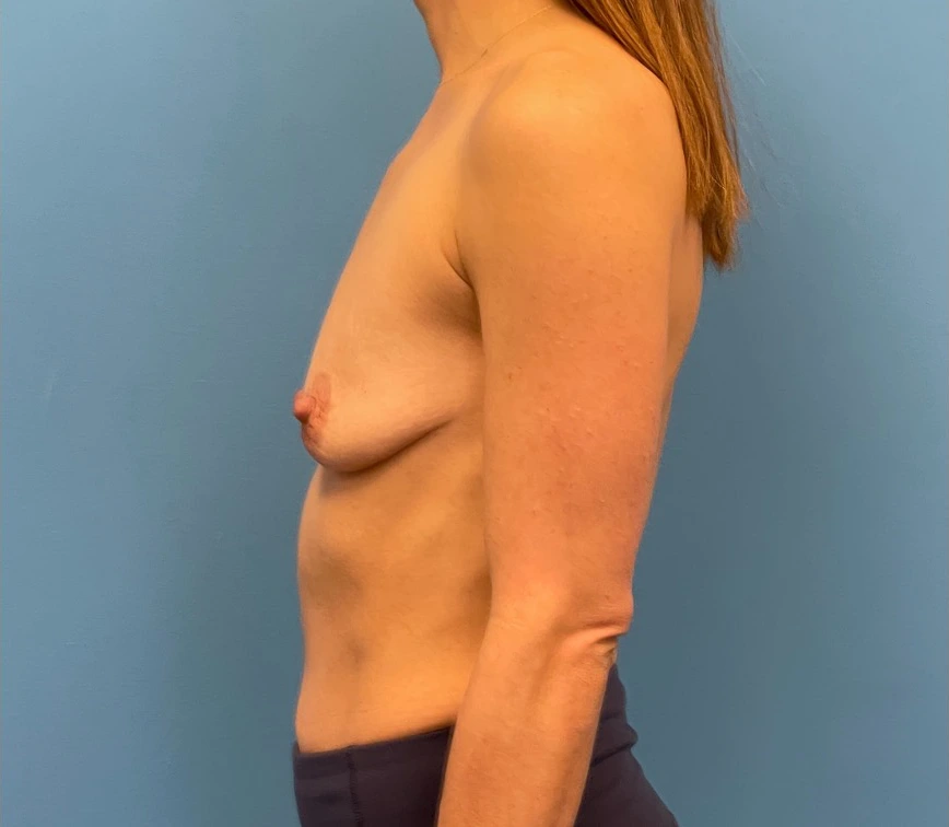 Breast-Augmentation-Mastopexy-Case--25025 | Before Breast Augmentation With Lift 2