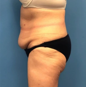 Case--251 | Before Liposuction 2