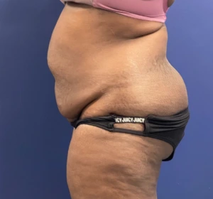 Case--257 | Before Liposuction 2