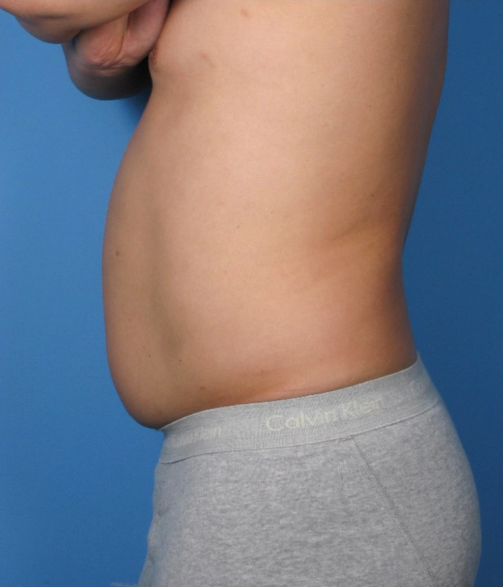 Case--389 | Before Liposuction 2