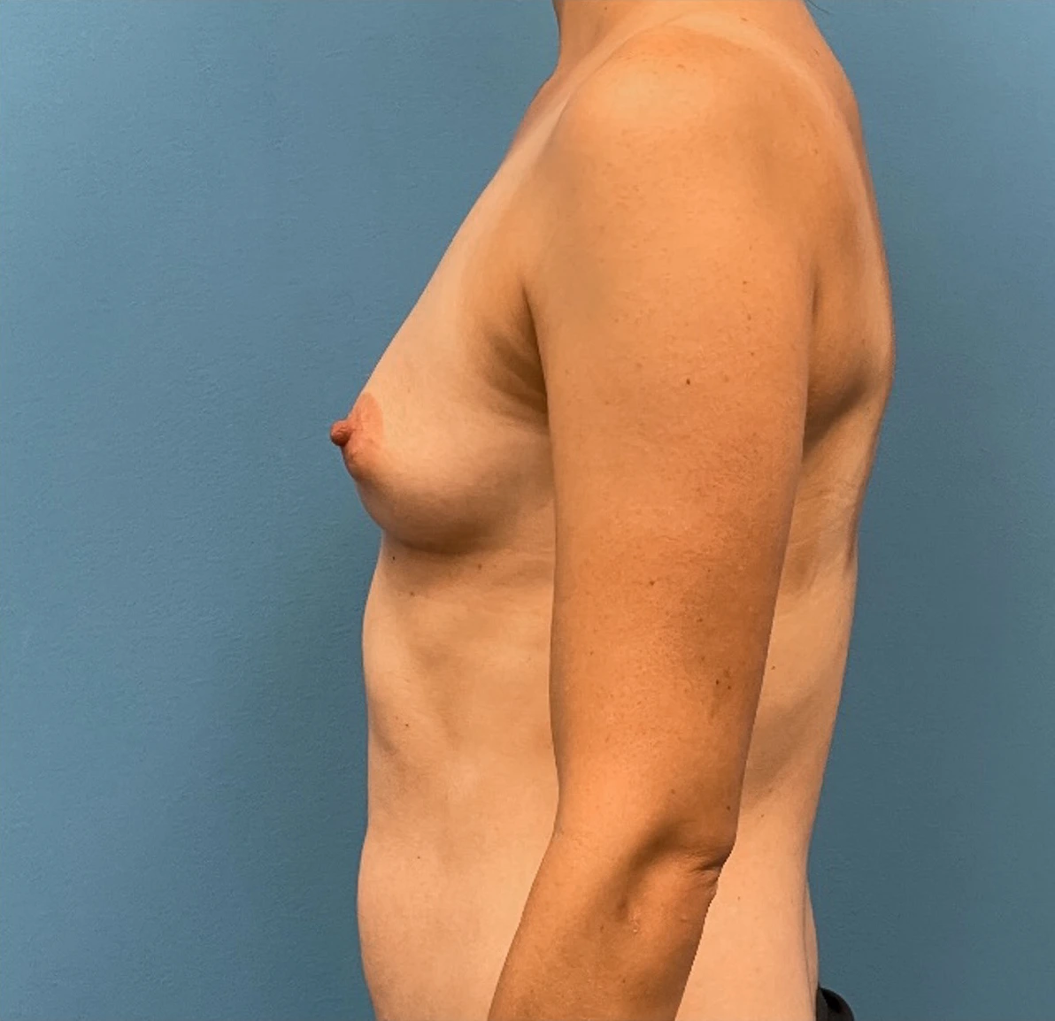 Breast-Reconstruction-Case--25209 | Before Breast Reconstruction 2