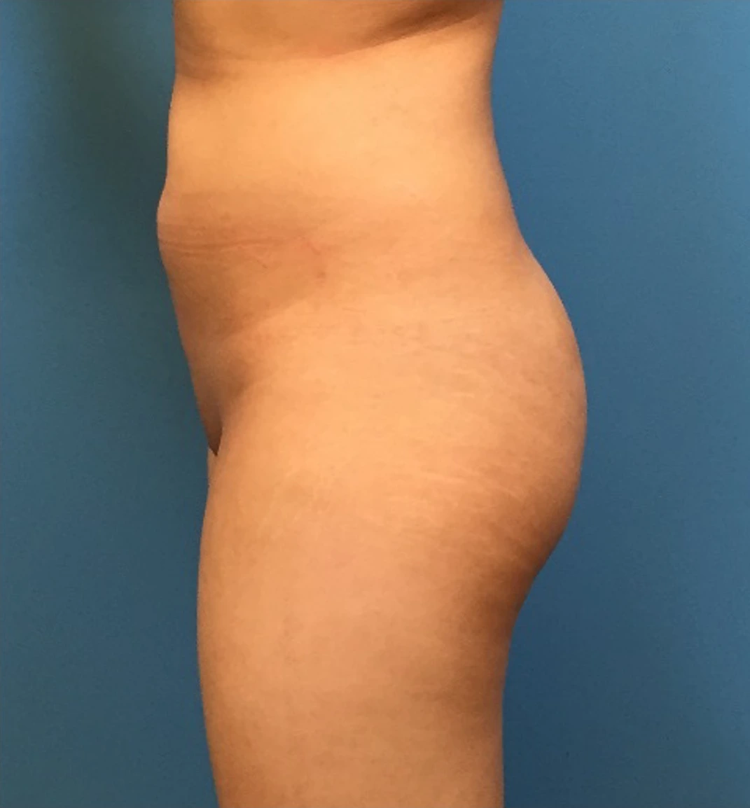 Brazilian-Butt-Lift-Case--73 | Before Brazilian Butt Lift 2