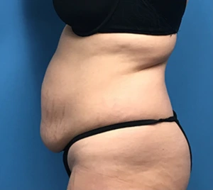 Case--56 | Before Liposuction 2