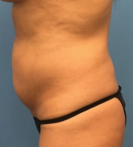 Case--65 | Before Liposuction 2