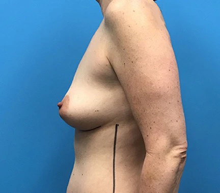 Case--96 | Before Breast Augmentation 3