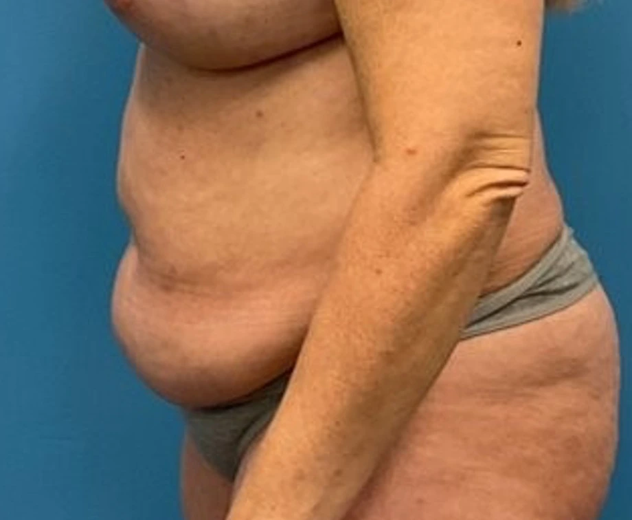 Liposuction-Tummy-Tuck-Case--25682-2 | Before Liposuction 3