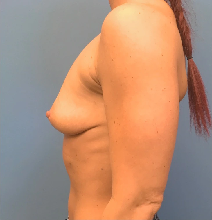 Case--17251 | Before Breast Augmentation 3