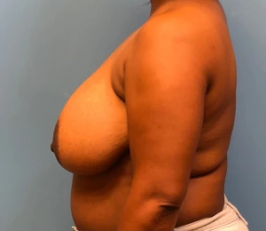 Breast-Reduction-Case--12894 | Before Breast Reduction 2