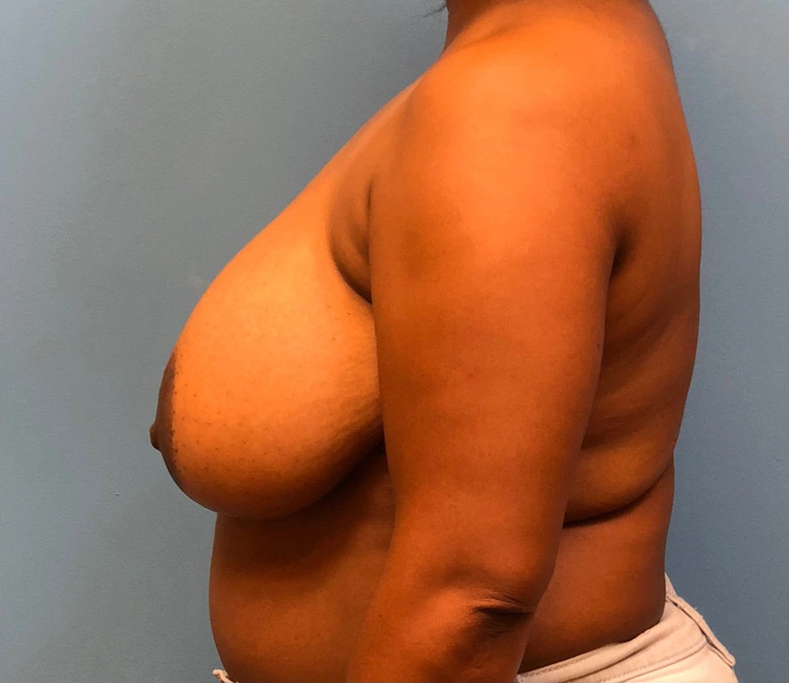 Breast-Reduction-Case--12894 | Before Breast Reduction 2