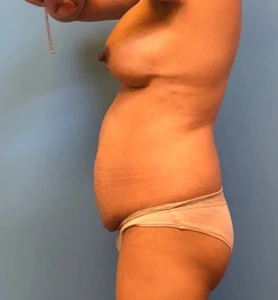 Case--11542 | Before Tummy Tuck 2