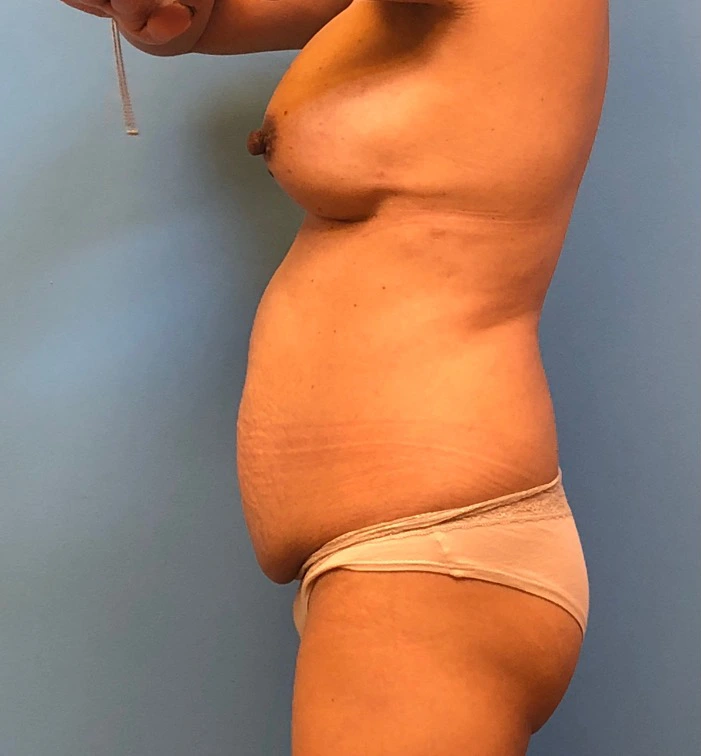 Case--11542 | Before Breast Reconstruction 2