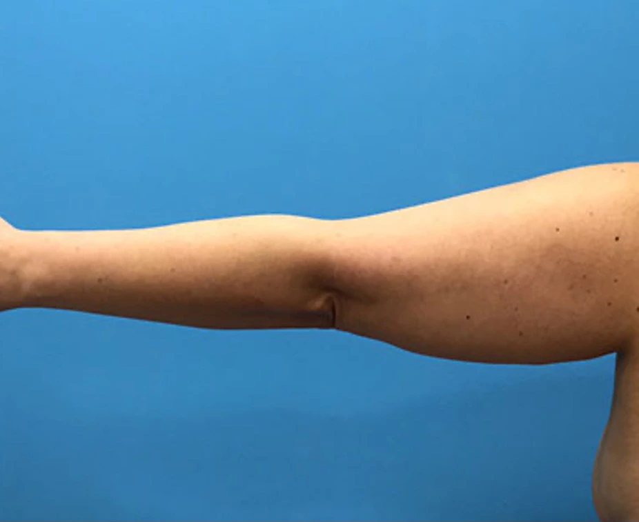Brachioplasty-Case--78 | Before Arm Lift 4