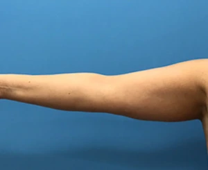 Brachioplasty-Case--78 | Before Arm Lift 1